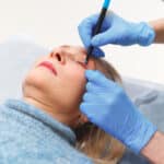 The Younger Facelift Patient in the GLP-1 Era