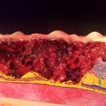 Study to Test AI Burn Assessment for Head, Hand, and Foot Injuries